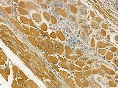 Caldesmon Antibody - AF6411 at 1/100 staining human tongue carcinoma by IHC-P.