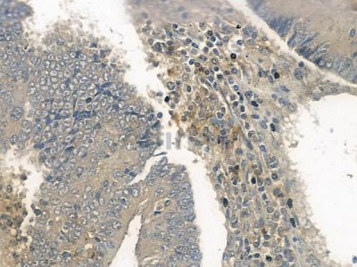 G3BP-1 Antibody - AF6427 at 1/100 staining human colon carcinoma by IHC-P.