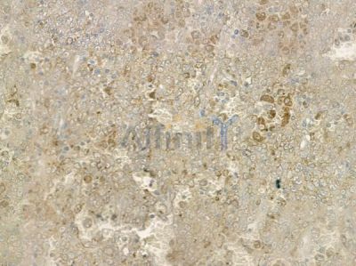 BIK Antibody - AF6428 at 1/100 staining human melanoma by IHC-P.