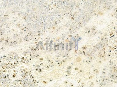 CPI17alpha Antibody - AF6473 at 1/100 staining human melanoma by IHC-P.