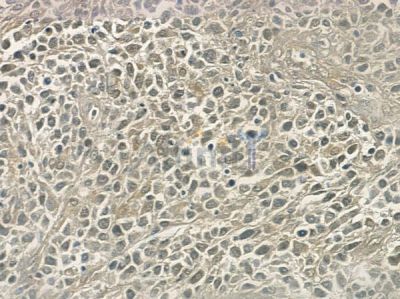 p62Dok Antibody - AF6479 at 1/100 staining human non-Hodgkin lymphoma by IHC-P.