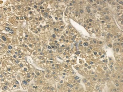 p62Dok Antibody - AF6479 at 1/100 staining human hepatocellular carcinoma by IHC-P.