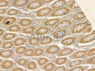 TFEB Antibody - AF7015 at 1/100 staining human colon carcinoma by IHC-P.