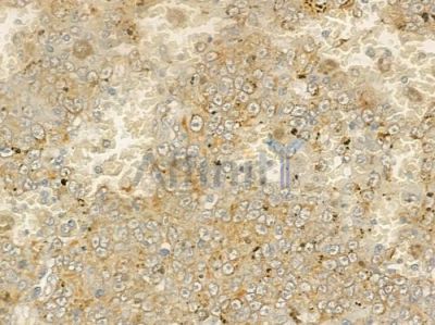 ABCB11 Antibody - AF7593 at 1/100 staining human melanoma by IHC-P.