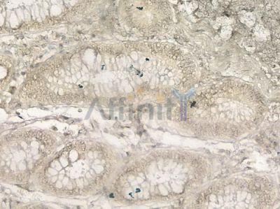 MyoD1 Antibody - AF7733 at 1/100 staining human colon carcinoma by IHC-P.