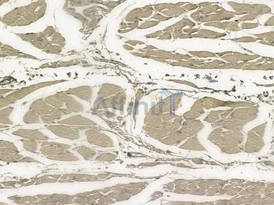 Phospho-CDK1/CDC2 (Thr161) Antibody - AF8001 at 1/100 staining human tongue carcinoma by IHC-P.