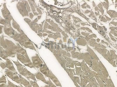 Phospho-LRP6 (Thr1479) Antibody - AF8343 at 1/100 staining human tongue carcinoma by IHC-P.