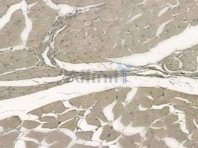 Phospho-LRP6 (Thr1479) Antibody - AF8343 at 1/100 staining human tongue carcinoma by IHC-P.
