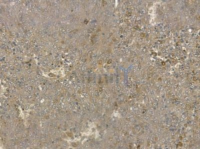 Phospho-PGK1 (Tyr324) Antibody - AF8608 at 1/100 staining human melanoma by IHC-P.