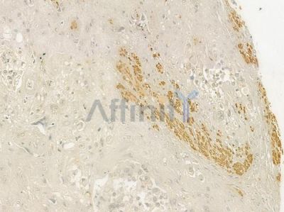 Actin-alpha/gamma Antibody - AF9004 at 1/100 staining human prostate carcinoma by IHC-P.