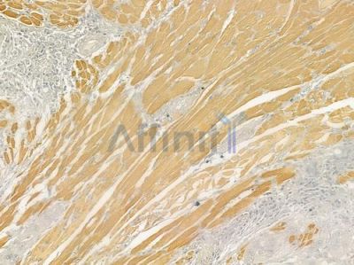 Actin-alpha/gamma Antibody - AF9004 at 1/100 staining human tongue carcinoma by IHC-P.
