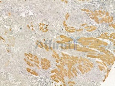 Actin-alpha/gamma Antibody - AF9004 at 1/100 staining human tongue carcinoma by IHC-P.
