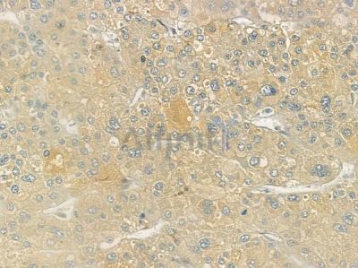 Arylsulfatase K Antibody - AF9020 at 1/100 staining human hepatocellular carcinoma by IHC-P.
