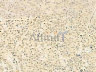 ASF1B Antibody - AF9022 at 1/100 staining human pituitary adenoma by IHC-P.