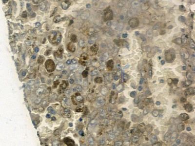BRD3 Antibody - AF9025 at 1/100 staining human melanoma by IHC-P.