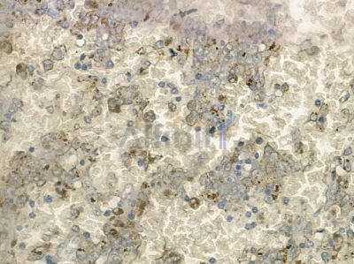COL19A1 Antibody - AF9044 at 1/100 staining human melanoma by IHC-P.