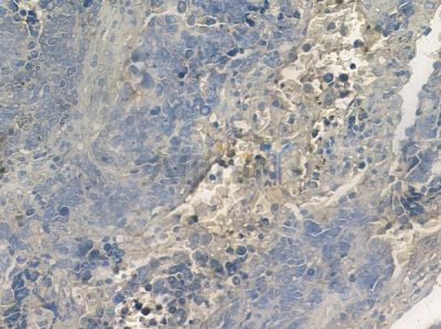 COL4A6 Antibody - AF9045 at 1/100 staining human small cell lung carcinoma by IHC-P.