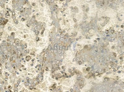 DCL-1 Antibody - AF9052 at 1/100 staining human liver cancer by IHC-P.