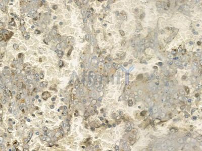 DCL-1 Antibody - AF9052 at 1/100 staining human melanoma by IHC-P.