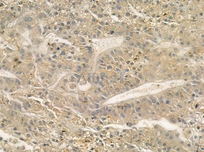 Grap Antibody - AF9079 at 1/100 staining human ovarian cancer and para-carcinoma tissue by IHC-P.