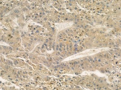 Grap Antibody - AF9079 at 1/100 staining human hepatocellular carcinoma by IHC-P.