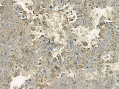 KIF13B Antibody - AF9100 at 1/100 staining human liver cancer by IHC-P.