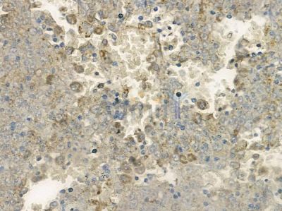 KIF13B Antibody - AF9100 at 1/100 staining human melanoma by IHC-P.