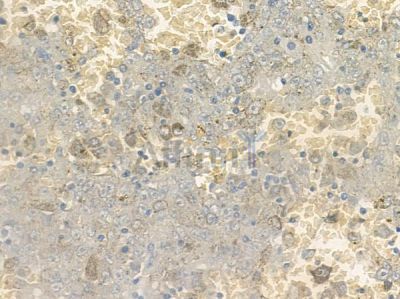 GIRK1/KIR3.1/KCNJ3 Antibody - AF9101 at 1/100 staining human melanoma by IHC-P.