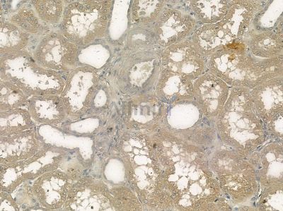 MRGF Antibody - AF9117 at 1/100 staining human pancreatic cancer by IHC-P.
