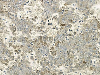 NDUFS5 Antibody - AF9124 at 1/100 staining human liver cancer by IHC-P.