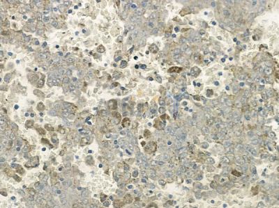 NDUFS5 Antibody - AF9124 at 1/100 staining human melanoma by IHC-P.