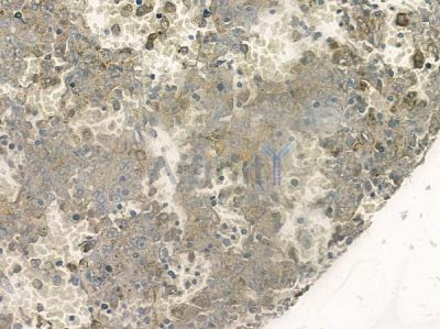 Nox3 Antibody - AF9134 at 1/100 staining human melanoma by IHC-P.