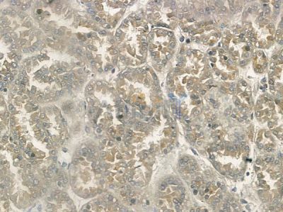 Rab 34 Antibody - AF9174 at 1/100 staining human renal cell carcinoma by IHC-P.