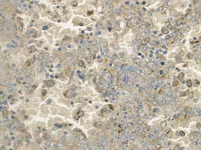 TDE1 Antibody - AF9212 at 1/100 staining human melanoma by IHC-P.