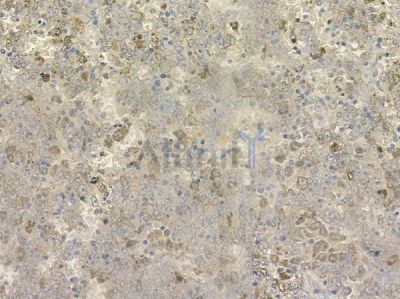 WAVE1 Antibody - AF9229 at 1/100 staining human melanoma by IHC-P.