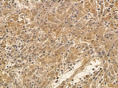 EIF5 Mouse Monoclonal Antibody - BF8550 at 1/100 staining human pancreatic cancer and para-carcinoma tissue by IHC-P.