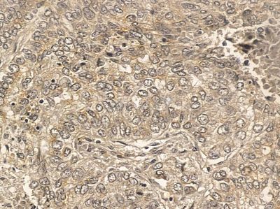 MSK2 Mouse Monoclonal Antibody - BF8553 at 1/100 staining human lung cancer by IHC-P.
