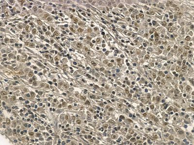 Nucleophosmin Mouse Monoclonal Antibody - BF8554 at 1/100 staining human gastric cancer by IHC-P.