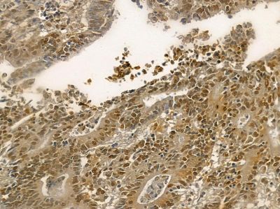 Nucleophosmin Mouse Monoclonal Antibody - BF8554 at 1/100 staining human prostate cancer by IHC-P.