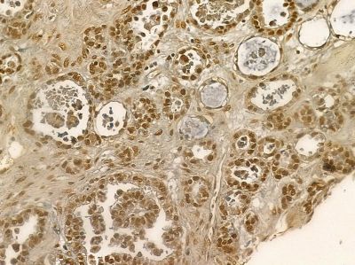 Nucleophosmin Mouse Monoclonal Antibody - BF8554 at 1/100 staining human ovarian cancer by IHC-P.