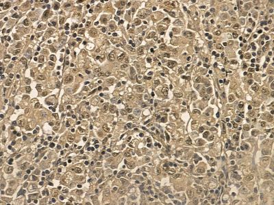 Hsp90 beta Mouse Monoclonal Antibody - BF8555 at 1/100 staining human gastric cancer by IHC-P.