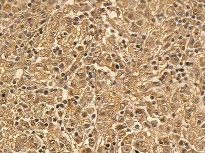 EEF2 Mouse Monoclonal Antibody - BF8556 at 1/100 staining human gastric cancer by IHC-P.