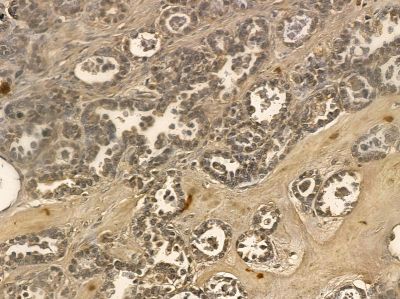 EEF2 Mouse Monoclonal Antibody - BF8556 at 1/100 staining human ovarian cancer by IHC-P.