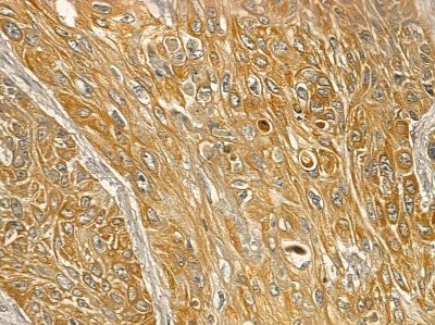 Mitofusin 2 Mouse Monoclonal Antibody - BF8563 at 1/100 staining human esophageal cancer and para-carcinoma tissue by IHC-P.