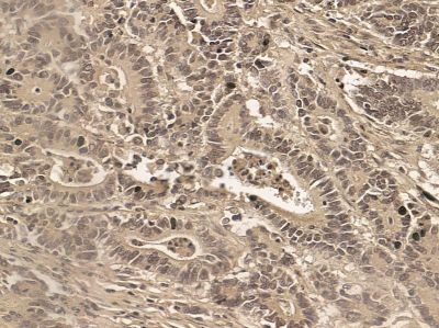 DNase I Mouse Monoclonal Antibody - BF8582 at 1/100 staining human prostate cancer by IHC-P.