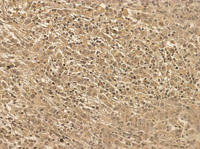 DNase I Mouse Monoclonal Antibody - BF8582 at 1/100 staining human gastric cancer by IHC-P.