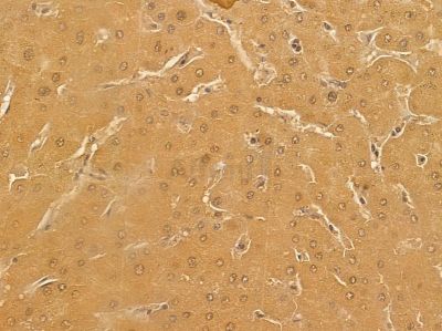 MURC Mouse Monoclonal Antibody - BF8584 at 1/100 staining human prostate cancer and para-carcinoma tissue by IHC-P.