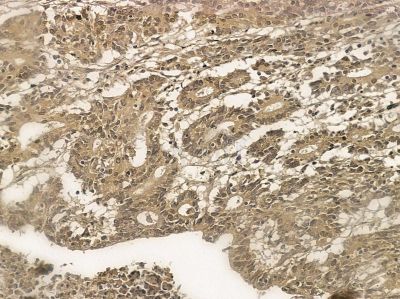 SCAI Mouse Monoclonal Antibody - BF8589 at 1/100 staining human prostate cancer by IHC-P.