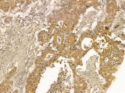 ALS2CR1 Mouse Monoclonal Antibody - BF8591 at 1/100 staining human colorectal cancer by IHC-P.