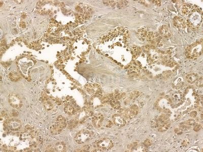 ALS2CR1 Mouse Monoclonal Antibody - BF8591 at 1/100 staining human ovarian cancer by IHC-P.